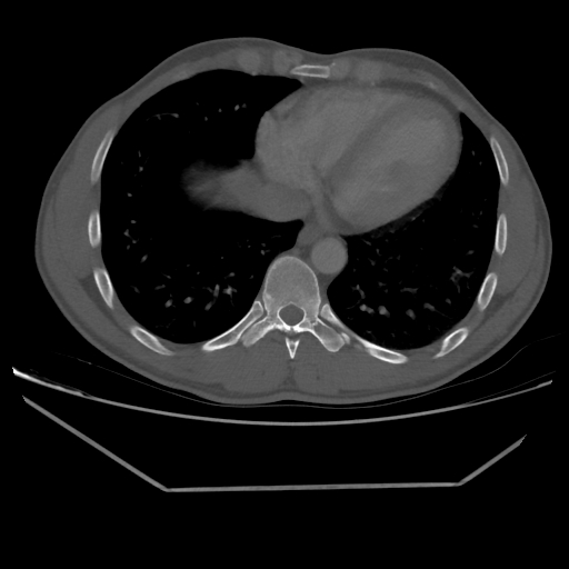 File:Aneurysmal bone cyst - rib (Radiopaedia 82167-96220 Axial bone window 185).jpg
