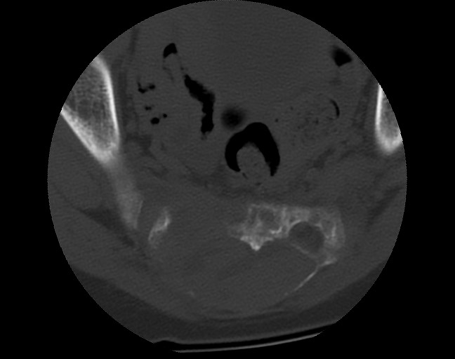 Aneurysmal bone cyst - sacrum (Radiopaedia 65190-74195 Axial bone window 32).jpg