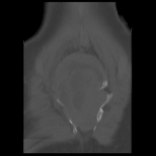 File:Aneurysmal bone cyst - sacrum (Radiopaedia 65190-74195 Coronal bone window 14).jpg