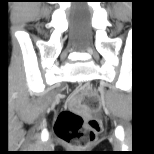 File:Aneurysmal bone cyst - sacrum (Radiopaedia 65190-74195 D 6).jpg