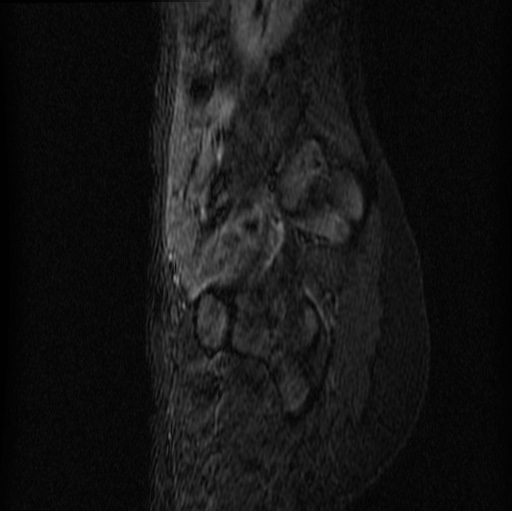 File:Aneurysmal bone cyst - sacrum (Radiopaedia 65190-74196 Sagittal STIR 10).jpg