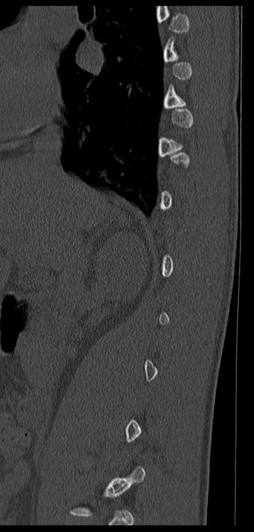 Aneurysmal bone cyst T11 (Radiopaedia 29294-29721 Sagittal bone window 59).jpg