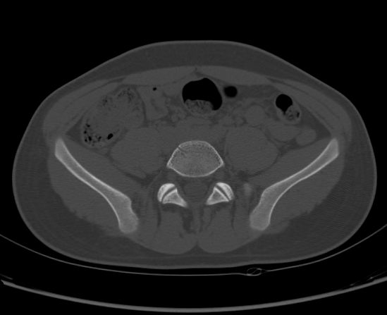 File:Aneurysmal bone cyst of ischium (Radiopaedia 25957-26094 Axial bone window 14).png