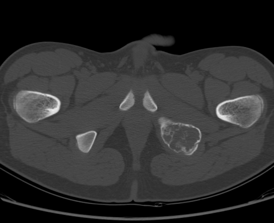 File:Aneurysmal bone cyst of ischium (Radiopaedia 25957-26094 Axial bone window 73).png