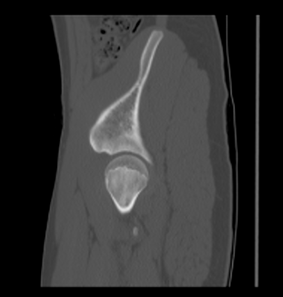 Aneurysmal bone cyst of ischium (Radiopaedia 25957-26094 Sagittal bone window 16).png