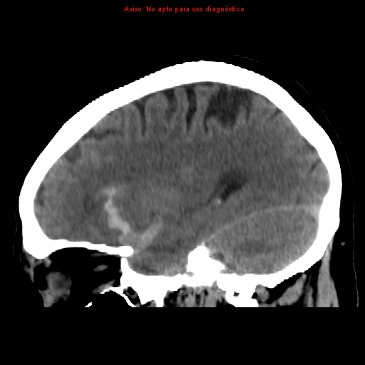 File:Aneurysmal subarachnoid hemorrhage (Radiopaedia 24740-24997 non-contrast 16).jpg