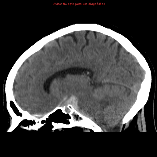 File:Aneurysmal subarachnoid hemorrhage (Radiopaedia 24740-24997 non-contrast 23).jpg