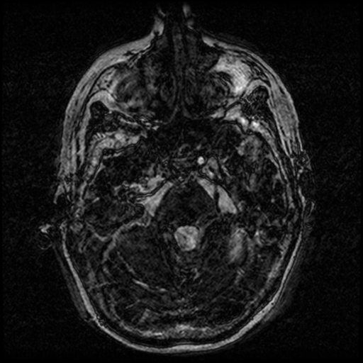 Angioinvasive aspergillosis in the pituitary fossa (Radiopaedia 39676-42010 Ax 3D FIESTA VOLUME 26).png