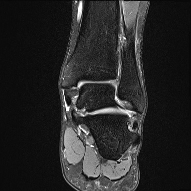 Ankle syndesmotic injury (Radiopaedia 69066-78837 Coronal PD fat sat 27).jpg