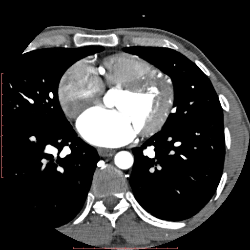 File:Anomalous left coronary artery from the pulmonary artery (ALCAPA) (Radiopaedia 70148-80181 A 177).jpg