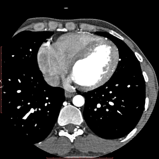 File:Anomalous left coronary artery from the pulmonary artery (ALCAPA) (Radiopaedia 70148-80181 A 247).jpg