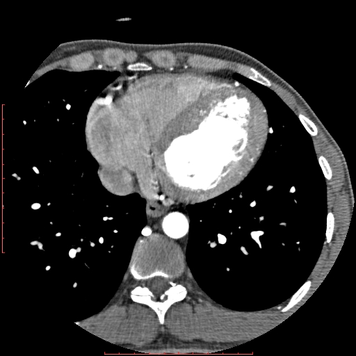 Anomalous left coronary artery from the pulmonary artery (ALCAPA) (Radiopaedia 70148-80181 A 261).jpg