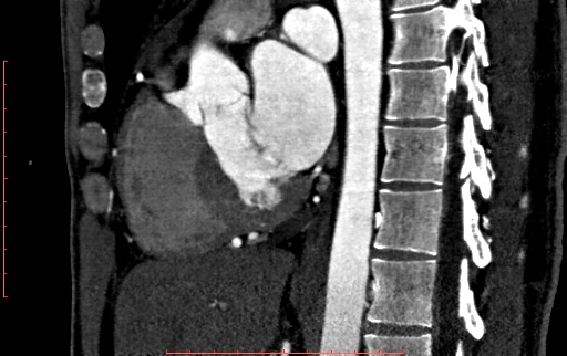 File:Anomalous left coronary artery from the pulmonary artery (ALCAPA) (Radiopaedia 70148-80181 C 122).jpg