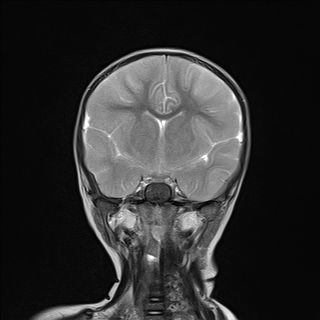 File:Anoxic brain injury (Radiopaedia 79165-92139 Coronal T2 12).jpg