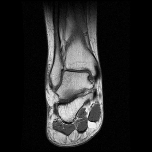 File:Anterior calcaneal process fracture (Radiopaedia 71377-81705 Coronal T1 9).jpg