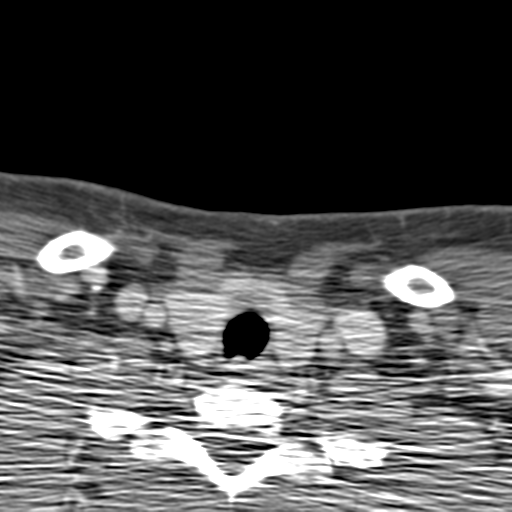 File:Anterior cerebral artery territory infarct (Radiopaedia 39327-41581 B 95).png