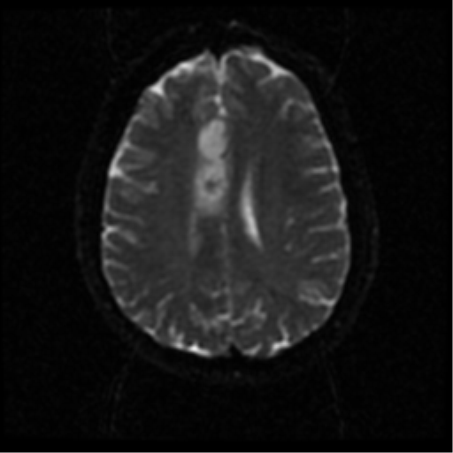 File:Anterior cerebral artery territory infarct (Radiopaedia 39327-41584 Axial DWI 42).png
