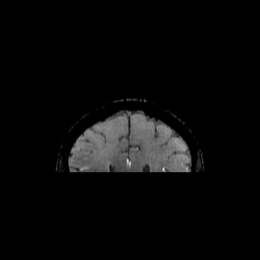 Anterior cingulotomy (ACING) (Radiopaedia 42950-46196 Coronal SWI 5).jpg