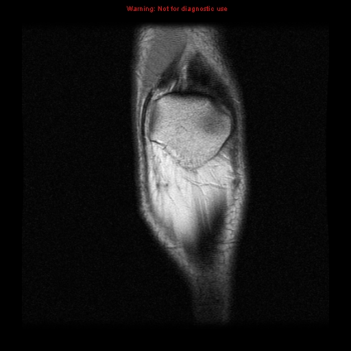 File:Anterior cruciate ligament injury - partial thickness tear (Radiopaedia 12176-12515 Coronal PD 1).jpg