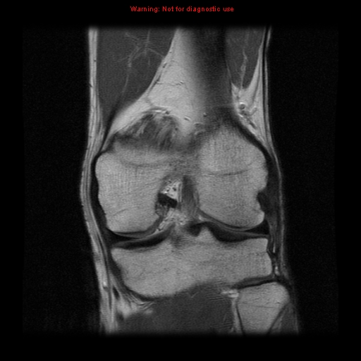 File:Anterior cruciate ligament injury - partial thickness tear (Radiopaedia 12176-12515 Coronal PD 12).jpg
