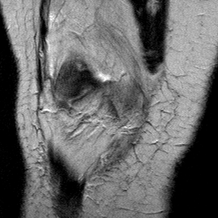 File:Anterior cruciate ligament mucoid degeneration (Radiopaedia 60853-68633 Coronal T2 9).jpg