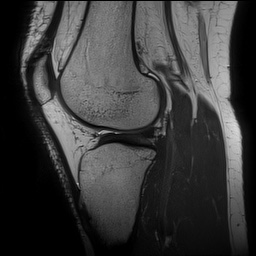File:Anterior cruciate ligament rupture and posteromedial corner injury (Radiopaedia 67338-76723 Sagittal PD 109).jpg