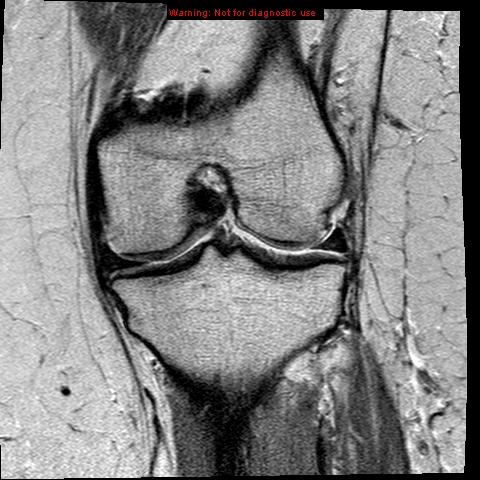 File:Anterior cruciate ligament tear (Radiopaedia 12329-12612 Coronal PD 13).jpg