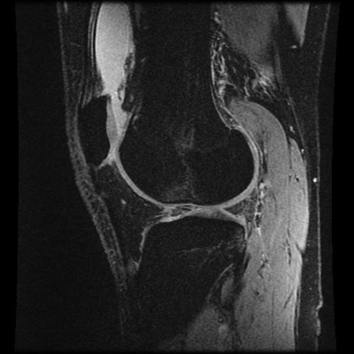 Anterior cruciate ligament tear (Radiopaedia 61500-69462 F 63).jpg