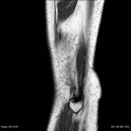 File:Anterior cruciate ligament tear (Radiopaedia 70783-80964 Sagittal T1 30).jpg