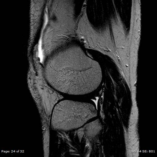 File:Anterior cruciate ligament tear (Radiopaedia 70783-80964 Sagittal T2 24).jpg