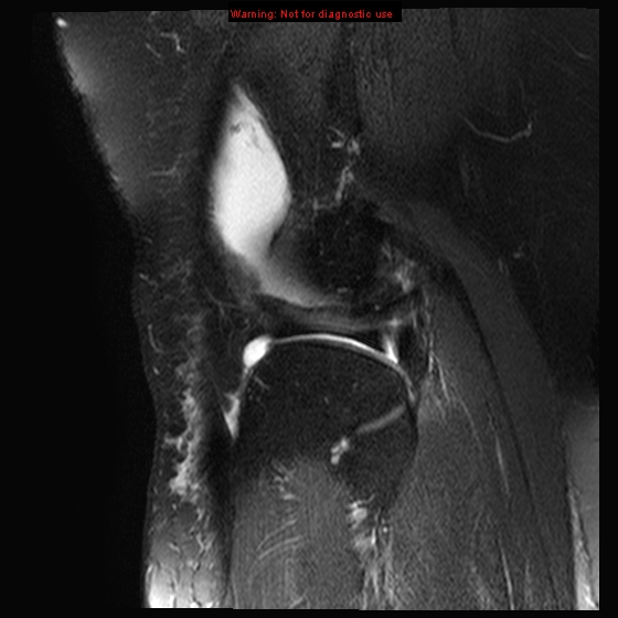 File:Anterior cruciate ligament tear - complete (Radiopaedia 12175-12514 Sagittal T2 fat sat 4).jpg