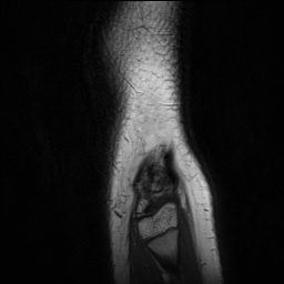 File:Anterior cruciate ligament tear - pediatric (Radiopaedia 62152-70260 Sagittal PD 164).jpg