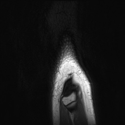 Anterior cruciate ligament tear - pediatric (Radiopaedia 62152-70260 Sagittal PD 169).jpg