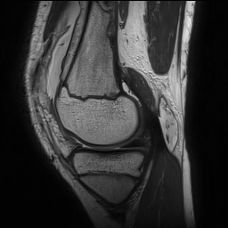 File:Anterior cruciate ligament tear - pediatric (Radiopaedia 62152-70260 Sagittal PD 61).jpg