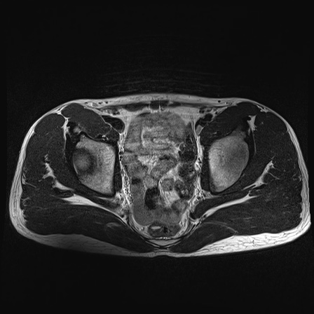 File:Anterior inferior iliac spine avulsion fracture (Radiopaedia 81312-95000 Axial T2 21).jpg