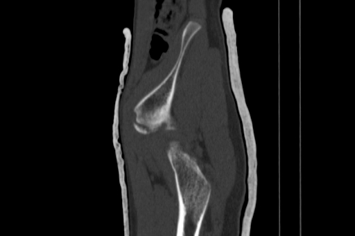 Anterior inferior iliac spine avulsion injury (Radiopaedia 88666-105376 Sagittal bone window 21).jpg