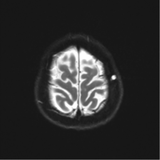 Anterior temporal lobe perivascular space (Radiopaedia 40946-43650 Axial DWI 25).png