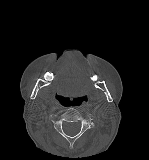 File:Anterior temporomandibular joint dislocation (Radiopaedia 59430-66784 Axial non-contrast 39).jpg