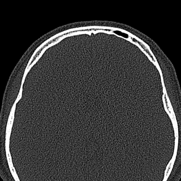 Antrochoanal polyp (Radiopaedia 30002-30554 Axial bone window 63).jpg