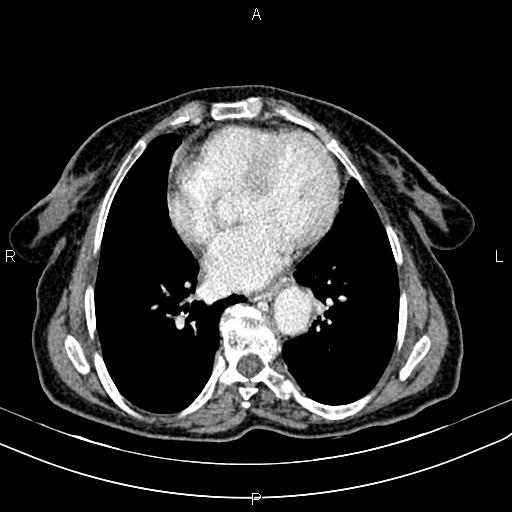 File:Aortic aneurysm and Lemmel syndrome (Radiopaedia 86499-102554 A 2).jpg