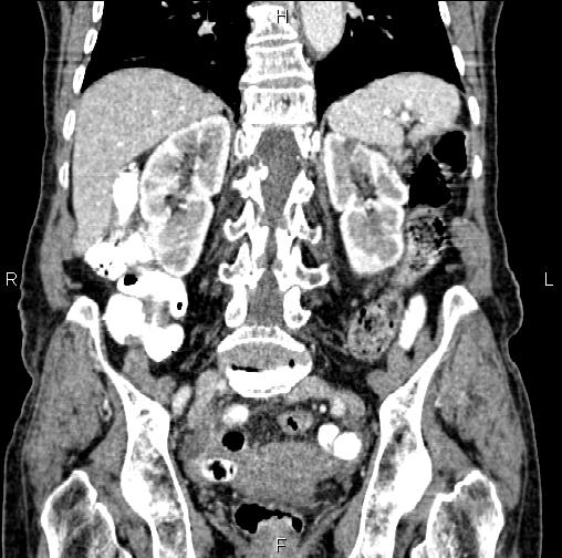 Aortic aneurysm and Lemmel syndrome (Radiopaedia 86499-102554 C 43).jpg