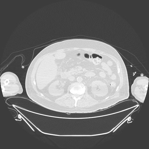 Aortic arch aneurysm (Radiopaedia 84109-99365 Axial lung window 336).jpg