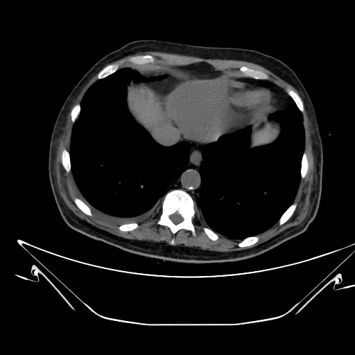 Aortic arch aneurysm (Radiopaedia 84109-99365 Axial non-contrast 225).jpg