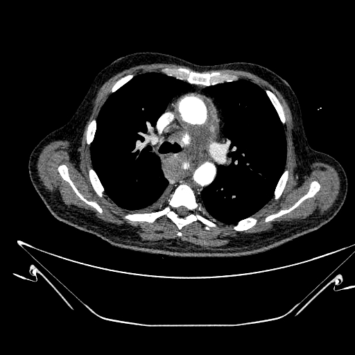 Aortic arch aneurysm (Radiopaedia 84109-99365 B 250).jpg