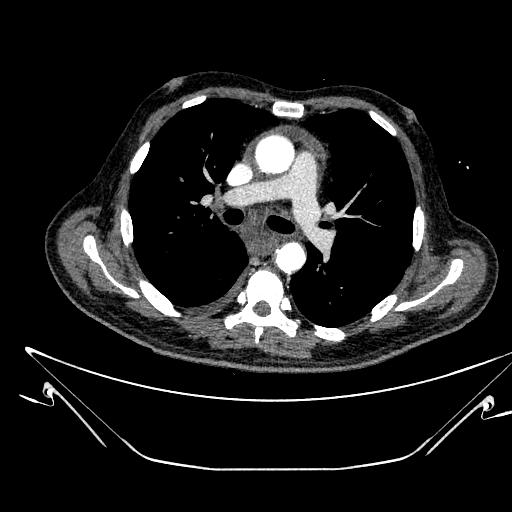Aortic arch aneurysm (Radiopaedia 84109-99365 B 278).jpg