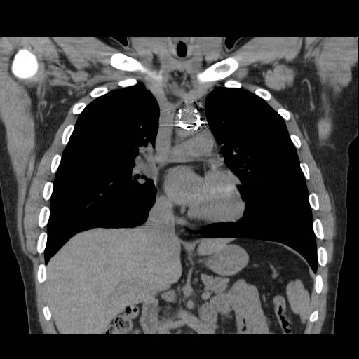File:Aortic arch stent (Radiopaedia 30030-30595 Coronal non-contrast 8).jpg