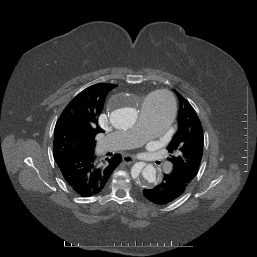 Aortic dissection- Stanford A (Radiopaedia 35729-37268 A 39).jpg