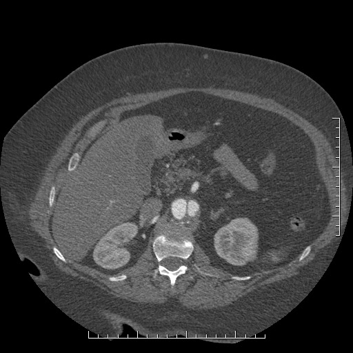 File:Aortic dissection- Stanford A (Radiopaedia 35729-37268 B 54).jpg