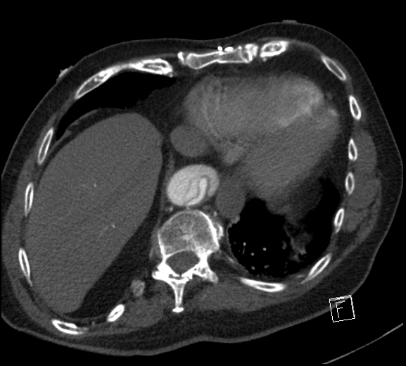 File:Aortic dissection (CTPA) (Radiopaedia 75506-86750 A 74).jpg