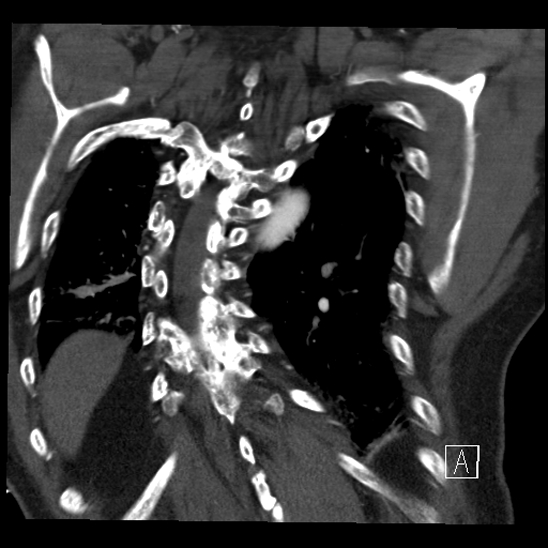 Aortic dissection (CTPA) (Radiopaedia 75506-86750 B 62).jpg